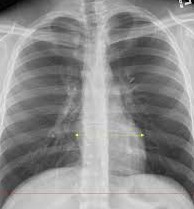 CHEST X-RAY PA VIEW